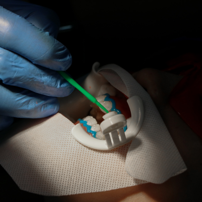 Root Canal Treatment