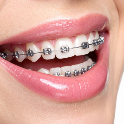 Braces and aligner
